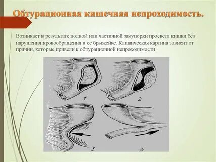 Острая обтурационная толстокишечная непроходимость
