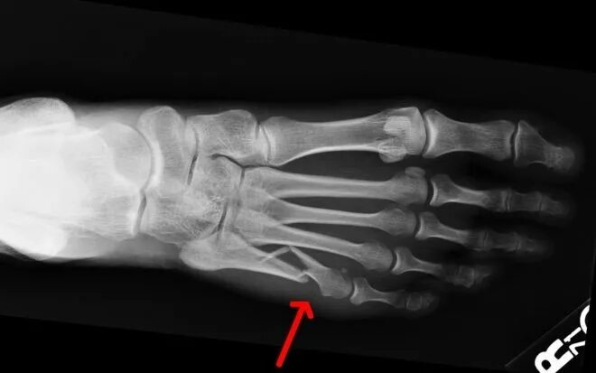 Трещина 5. Рентген перелома 5 плюсневой кости. Перелом пятой плюсневой кости стопы рентген. Перелом плюсневых костей стопы рентген. Перелом Джонса пятой плюсневой кости.