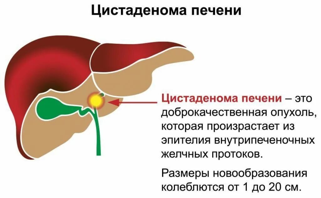 Кисты печени симптомы причины. Новообразование в печени. Многокамерная киста печени.