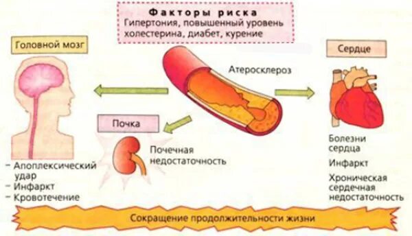 Факторы риска вторичной артериальной гипертензии. Артериальная гипертензия и атеросклероз. факторы риска гипертонической болезни атеросклероз. факторы развития атеросклероза. факторы развития гипертонии.