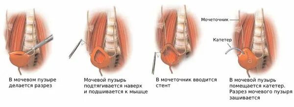 Травма мочеточника. Экстравезикальная реимплантация мочеточника. Антирефлюксная операция на мочеточниках. Реимплантации мочеточника.