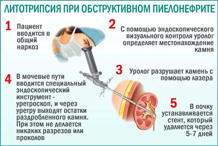 Необструктивный хронический пиелонефрит связанный. Обструктивный пиелонефрит. Дистанционная литотрипсия. Первичный необструктивный пиелонефрит. Литотрипсия протокол операции.