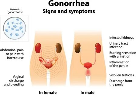Gonorrhea in Pregnancy 