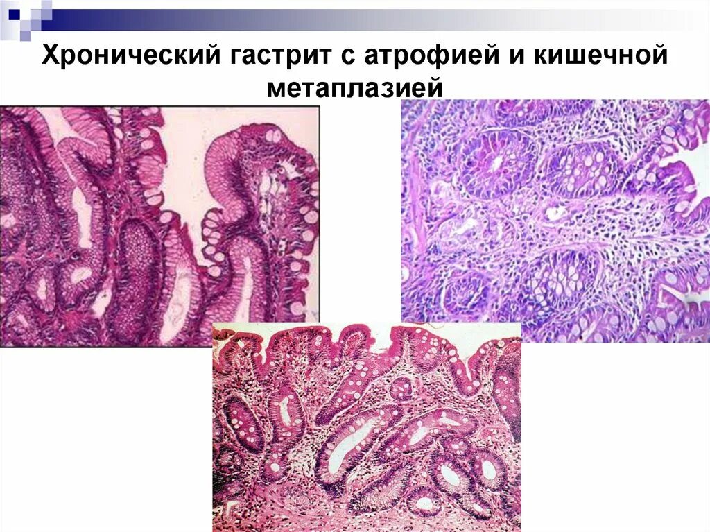 Полная метаплазия желудка. Атрофический гастрит гистология. Кишечная метаплазия патанатомия. Метаплазия желудка гистология. Метаплазия эпителия шейки.