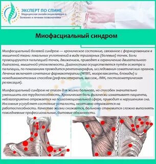 Миофасциальный синдром что это такое простым