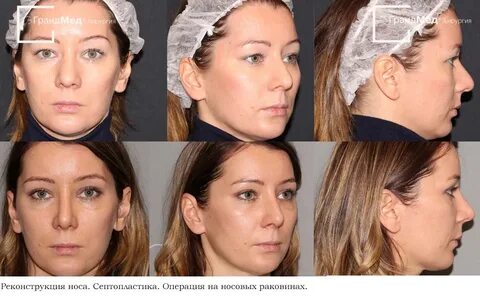 Ринопластика surgery 9mice kai