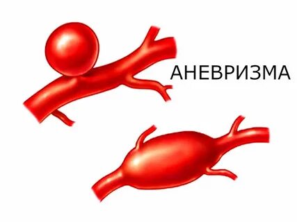 Главный сосуд