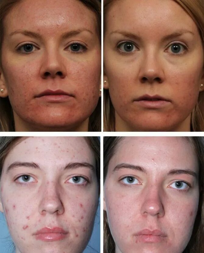 Процедуры после 30. Механическая чистки лица жо и после. Лицо до и после косметолога.