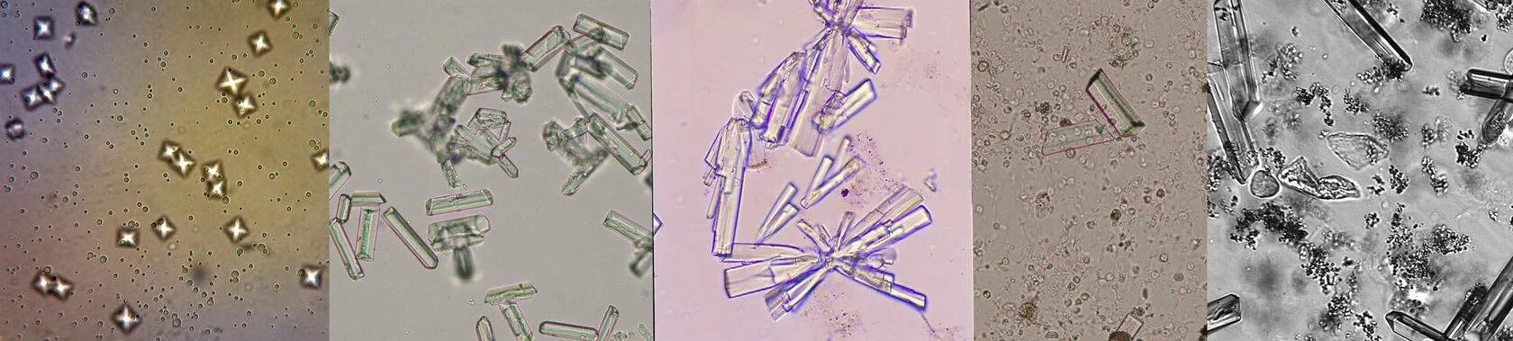 Струвиты и оксалаты микроскопия. Струвиты оксалаты трипельфосфаты. Струвиты микроскопия. Микроскопия мочи трипельфосфаты.