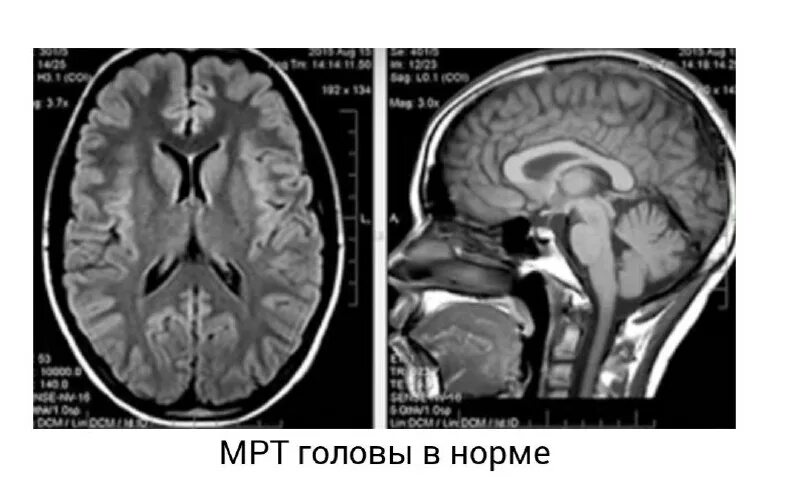 Томографии (кт, мрт, фмрт, пэт). Мрт головы норма. Компьютерная томография головного мозга норма. Норма мскт головного мозга. Мрт после кт время.