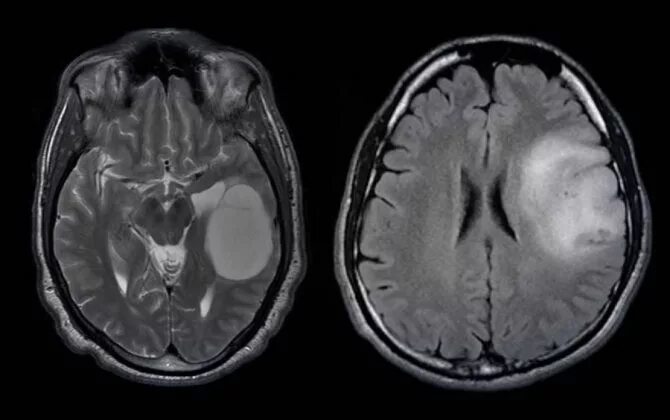 Глиобластома головного мозга мрт. Злокачественная глиобластома головного мозга снимок. Олигодендроглиома головного мозга кт. Опухоли гм