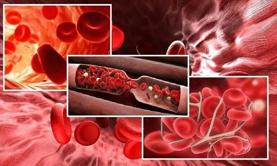 Тромб в кровеносном сосуде. Воспаление сосудистой стенки. Свертываемость и сгущение крови. Образование тромба попадание факторов