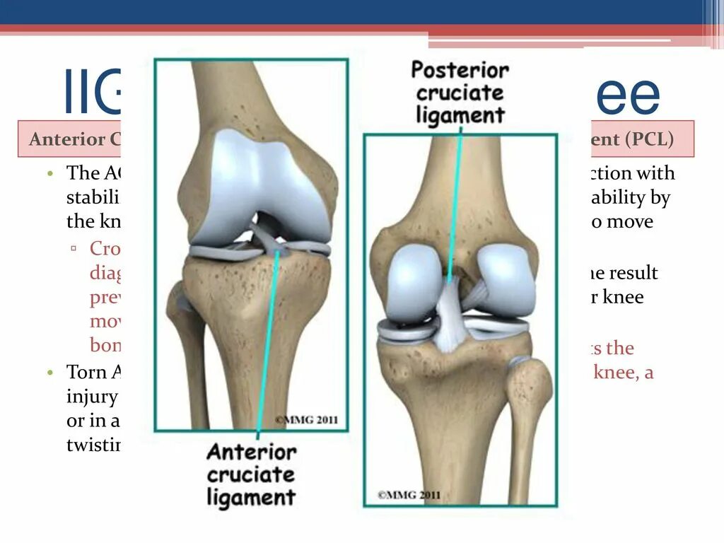 Симптомы крестообразной связки коленного сустава. Перерастяжение связок коленного сустава. ПКС (передняя крестообразная связка). ПКС связок коленного сустава. ПКС коленного сустава анатомия.