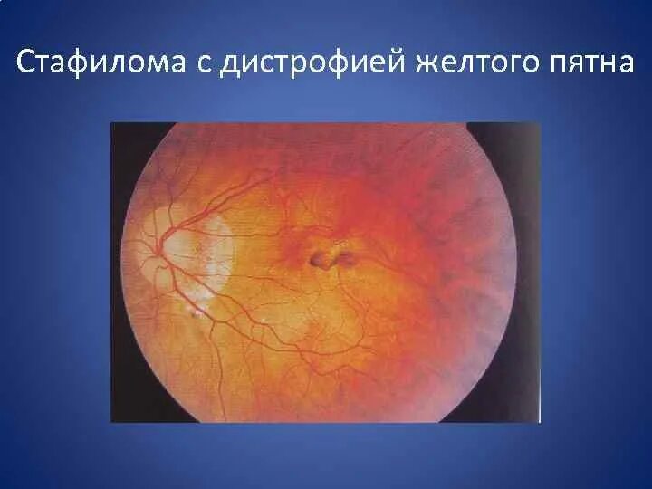 Миопическая дегенерация. Миопическая стафилома сетчатки. Экссудативная макулопатия. Миопическая дегенерация. Вителлиформная макулярная дистрофия.