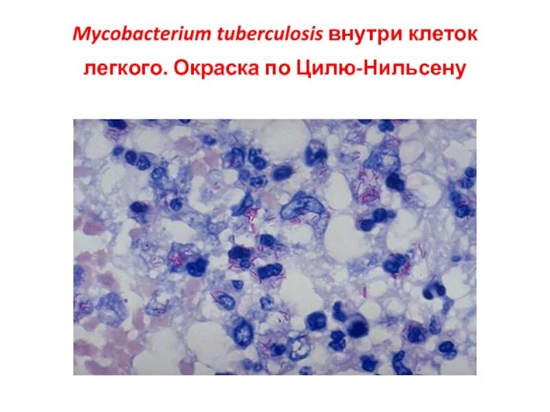 Мокрота по цилю нильсену. Микобактерии туберкулеза микроскопия мокроты. Окраска по Цилю Нильсену Mycobacterium. Микобактерии туберкулеза Циль Нильсен. Микобактерия туберкулеза по Цилю Нильсену.