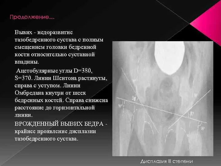 Полное расхождение суставных
