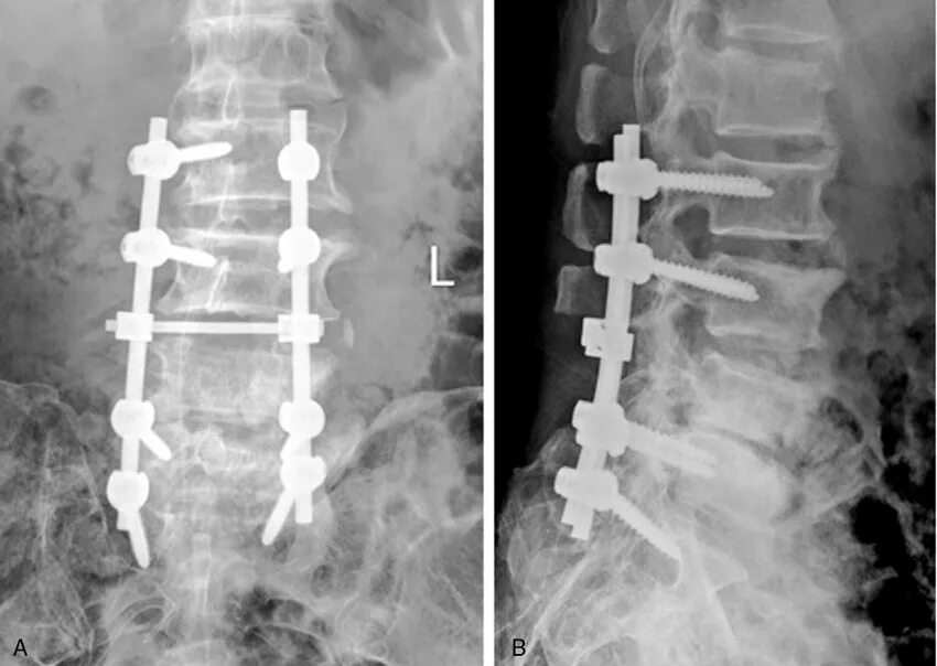 Остеосинтез позвоночника l1 транспедикулярной. Транспедикулярная фиксация l5-s1. Транспедикулярная фиксация позвоночника l1-s1 позвонков. Транспедикулярная фиксация l1-l2-l3-l4-l5 системой.