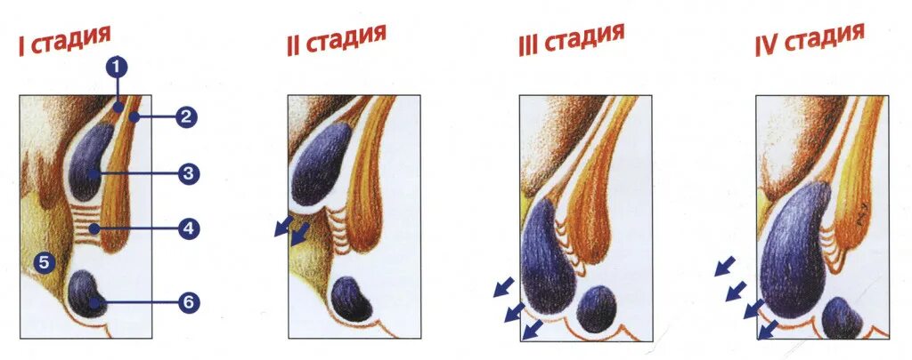 Лечение геморроя.