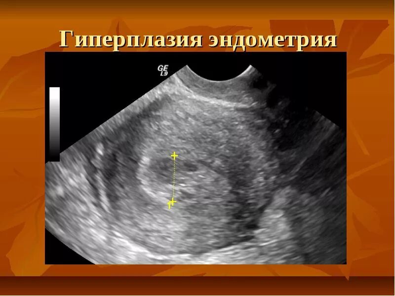 Гиперплазия полости матки. Эхограмма гиперплазии эндометрия. Гиперплазия эндометрия на УЗИ.