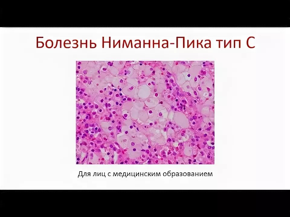 Тип пик. Пенистые клетки ниманна пика. болезнь ниманна пика гистология. синдром нимана пика клетка.