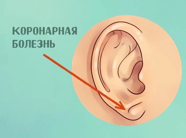 Диагональная складка на мочке уха признак франка. Диагональные складки на мочках ушей. поперечная складка на мочке уха..