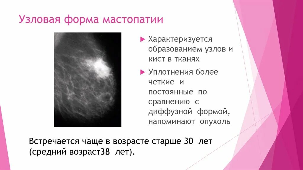 Диффузная фиброзная мастопатия молочных желез. Диффузная фиброзно-кистозная мастопатия рентген. узловая форма фиброзно-кистозной мастопатии. узи узловая фиброзно-кистозная мастопатия. узловая форма фкм молочной железы маммография.