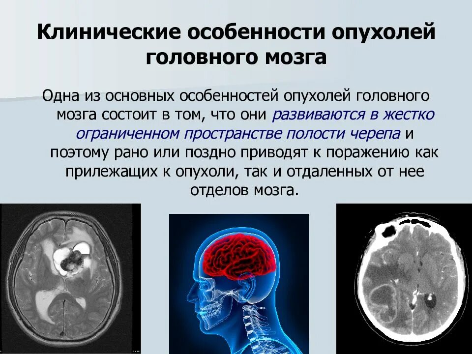 Симптомы опухоли головного мозга на ранних стадиях. Понятие злокачественности опухоли головного мозга. Клинические проявления опухоли головного мозга. Объемное образование головного мозга. Опухоль головного мозга симптомы.