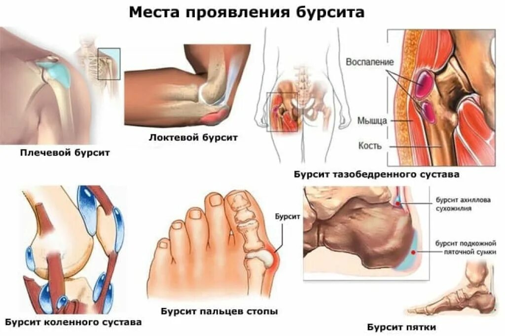 Гнойные заболевания суставов. Острый Гнойный бурсит локтевого. Околосуставные сумки локтевого сустава. Супрапателлярный бурсит Гнойный. Бурсит воспаление суставной сумки.