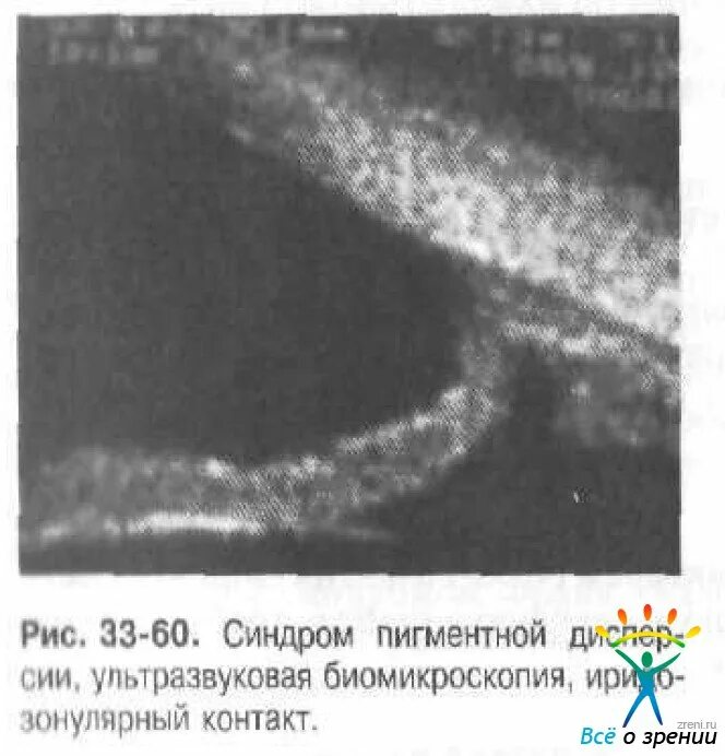 Дисперсия синдром. Синдром пигментной дисперсии. синдром пигментной дисперсии латентная стадия. синдром пигментной дисперсии глаза. лазерная иридэктомия при синдроме пигментной.