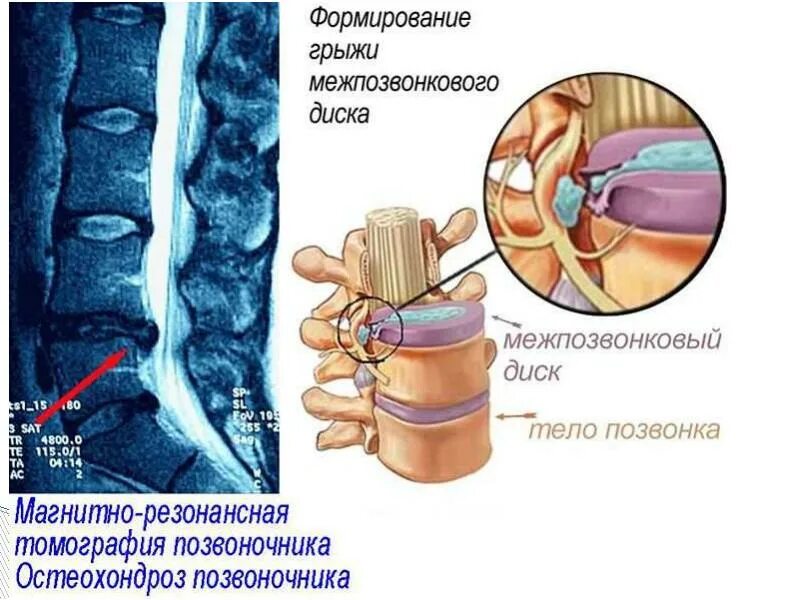 Остеохондроз шейного отдела протрузии. Остеохондроз шейного отдела грыжа межпозвоночного диска. Грыжи дисков поясничного отдела позвоночника. Межпозвонковые грыжи поясничного отдела. Грыжа позвонка поясничного отдела.