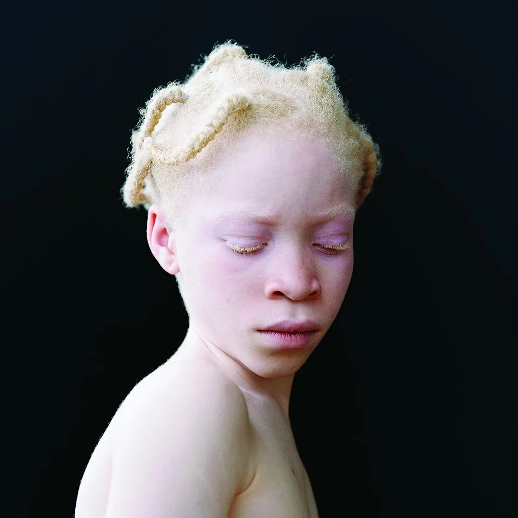 Глазно-кожный альбинизм. Окулокутанный альбинизм. Альбинос негроидной расы.