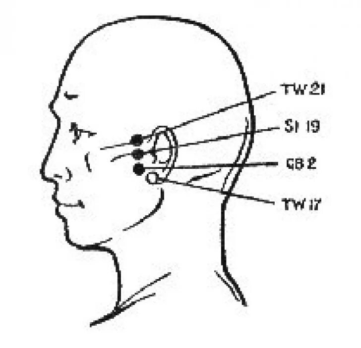 Болезненные точки на голове. Акупунктурная точка от шума в ушах. Акупунктурные точки при шуме в ушах и голове. Акупунктурные точки при боли в ухе. Точки акупунктуры при тугоухости.