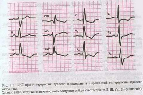Перегрузка на экг