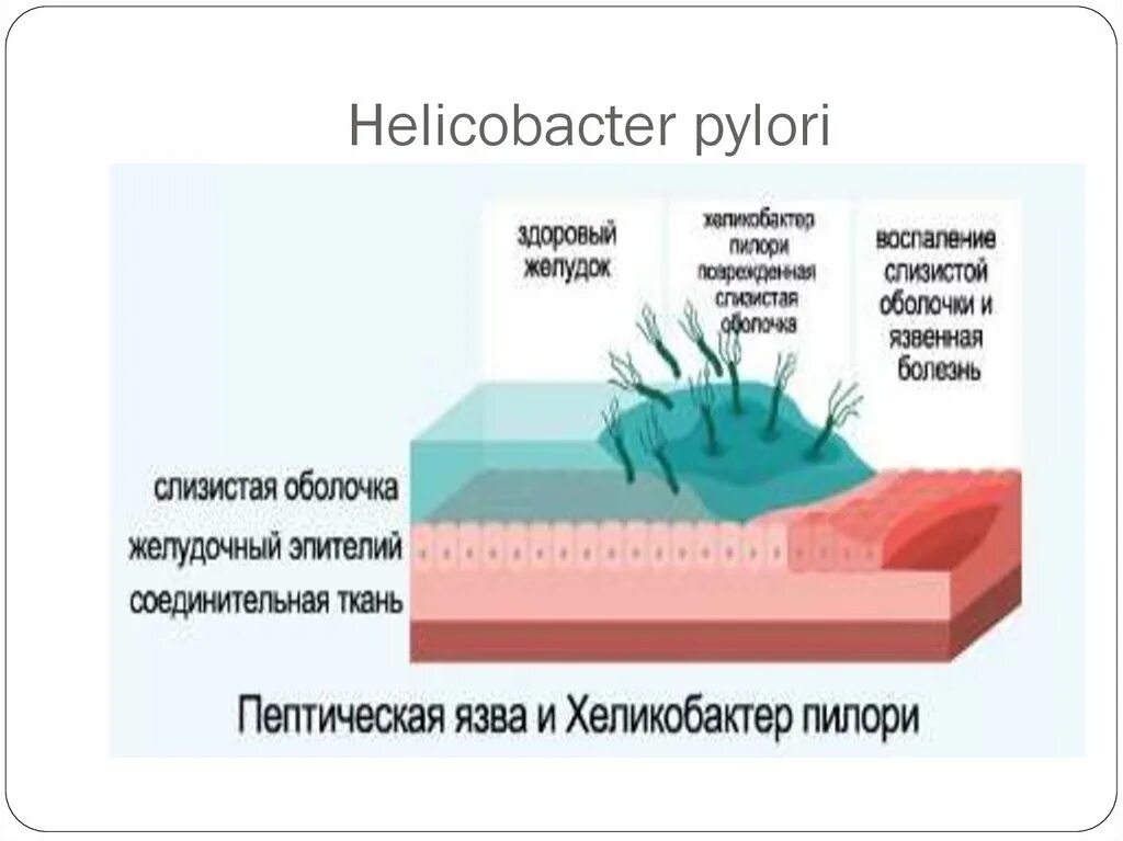 Распространенность инфекции h. pylori. Биоптата на Helicobacter pylori. Причины появления хеликобактер в желудке