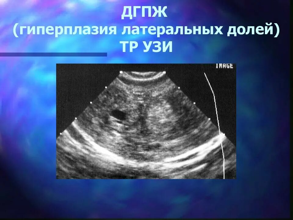 Гиперплазия предстательной железы УЗИ. Аденома предстательной железы на УЗИ. Гиперплазия предстательной железы 1