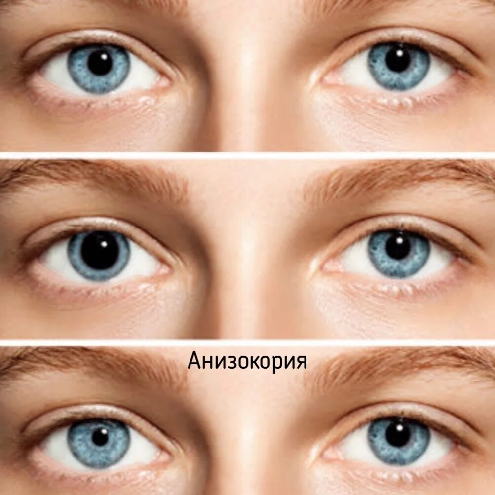 Fixed pupils
