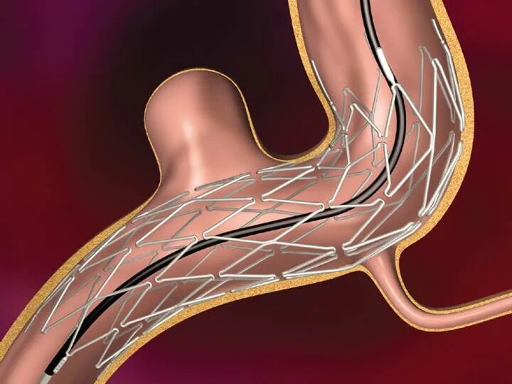 Транслюминальная баллонная ангиопластика. Стеноз сонной артерии кт. Стентирование артерий головы. Каротидное стентирование. Артериальная аневризма сосудов головного мозга.