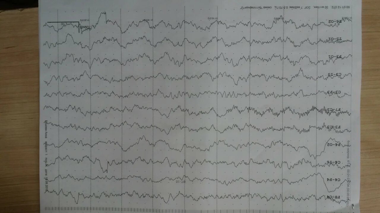 Видеомониторинг ЭЭГ ребенку. ЭЭГ мониторинг головного мозга. ЭЭГ при тревожном расстройстве. Человек на ЭЭГ. Ээг оренбург