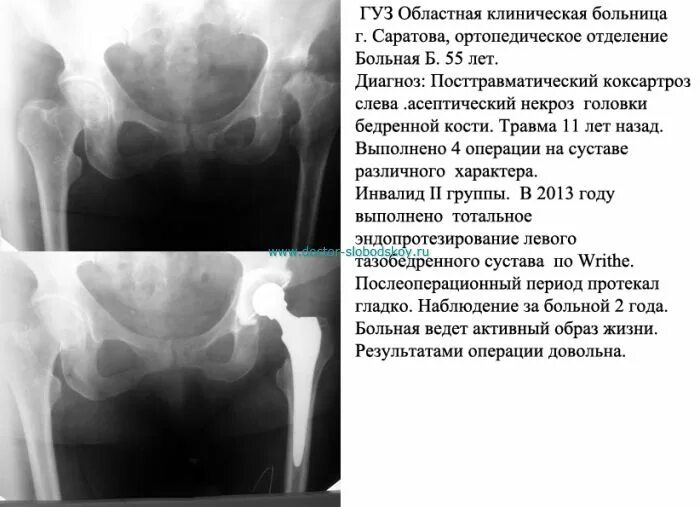 Артроз положена ли инвалидность. Коксартроз тазобедренного диагноз. коксартроз асептический некроз головки. коксартроз 4 степени тазобедренного. посттравматический коксартроз 2 степени.