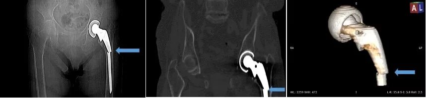 Мрт после эндопротезирования. Эндопротез тазобедренного сустава кт. Эндопротезирование тазобедренного сустава кт. Трехкомпонентный протез тазобедренного сустава кт. Эндопротез тазобедренного сустава кт протокол.