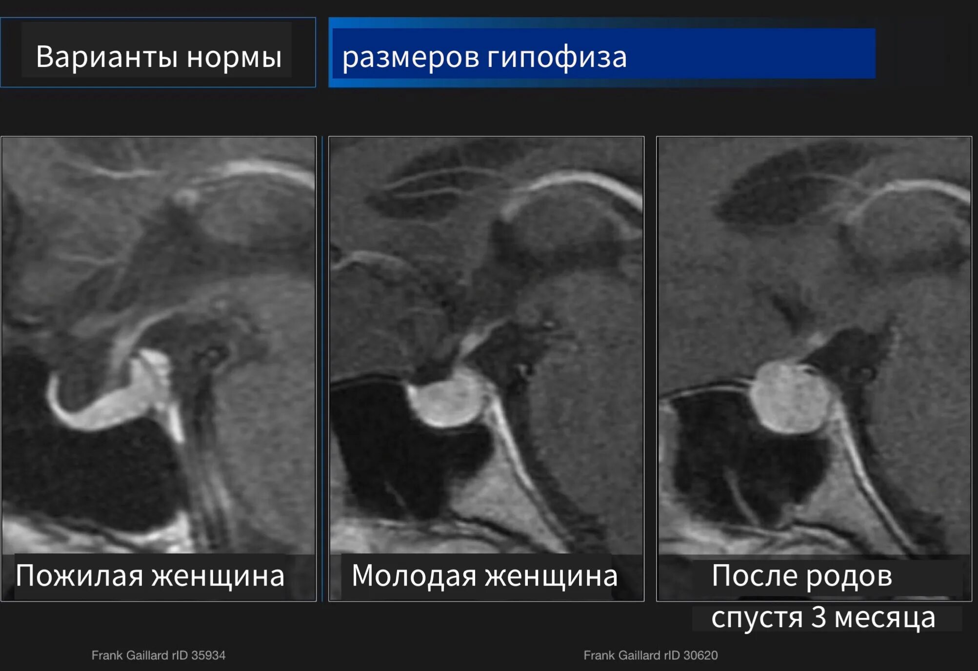 Размер гипофиза