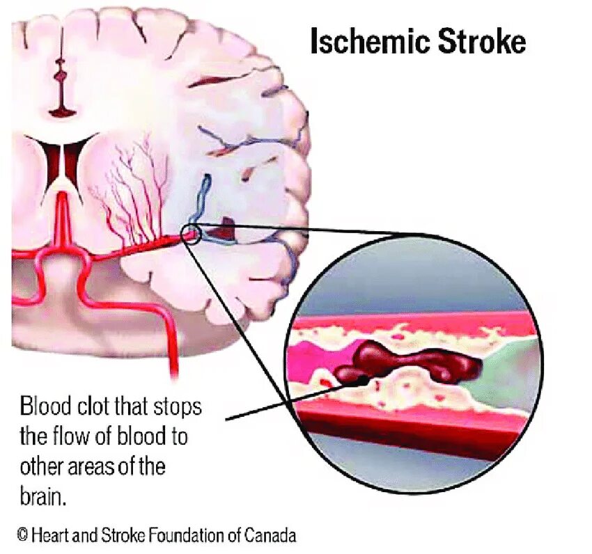 Тромботический ишемический инсульт. Тромбоз церебральных артерий. Тромбоз сосудов головного мозга. Тромбоз артерий мозга
