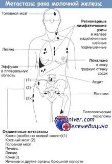 Рак молочной железы куда метастазы