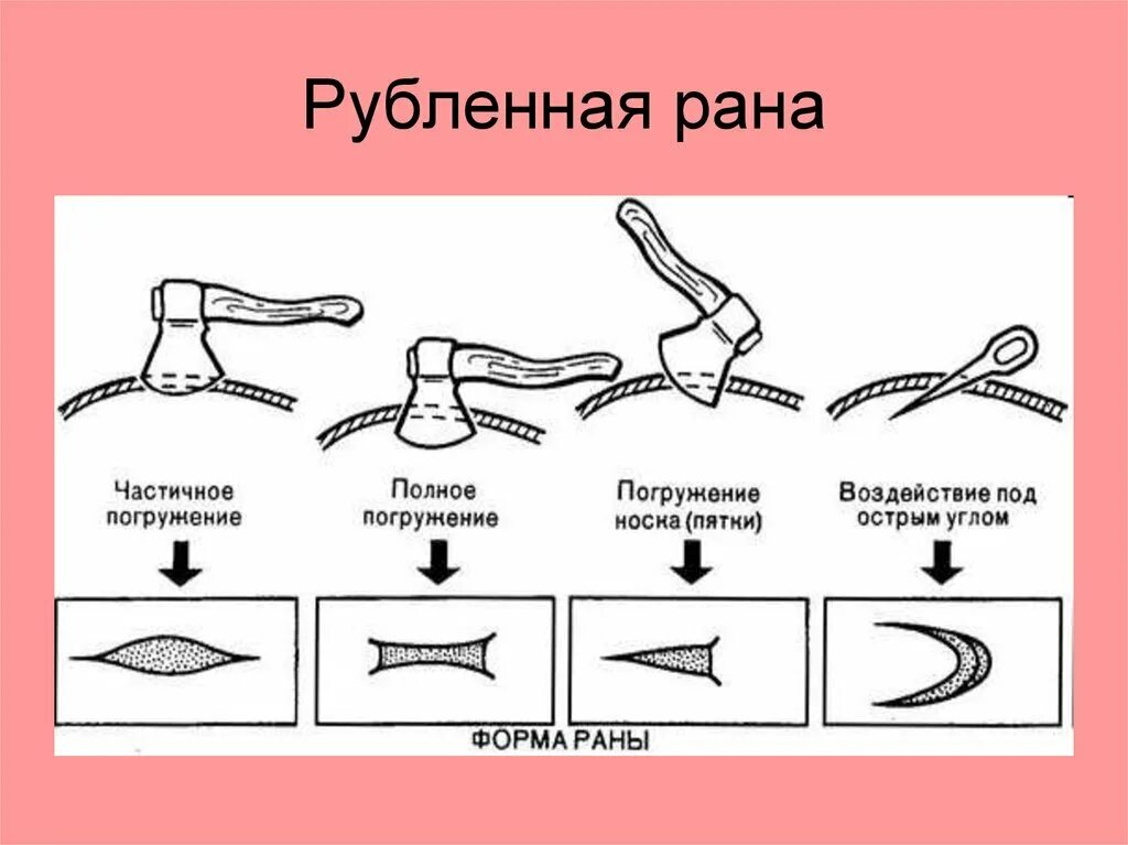 Повреждение причиненное ударом. Рубленная рана судебная медицина. Рубленые раны судебная медицина. Повреждения острыми предметами.