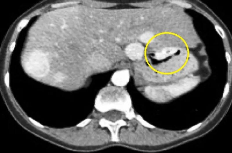 Гиперваскулярные метастазы печени кт. Гиподенсный очаг печени кт. Гиповаскулярные метастазы печени кт. Гиподенсивное образование в печени на кт. Гиподенсивное образование в печени