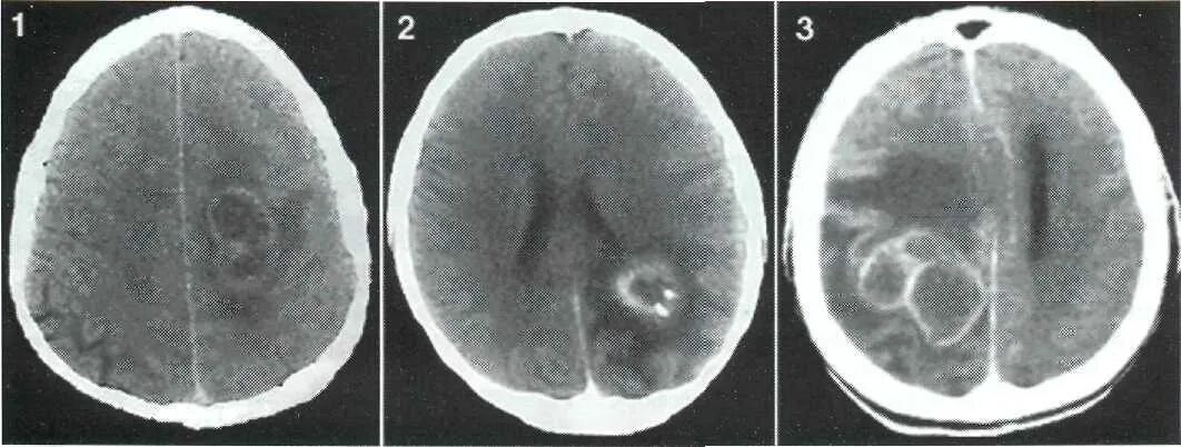 Глиома головного мозга кт. Глиобластома теменной области. Абсцесс головного мозга кт с контрастом. Опухоли теменной