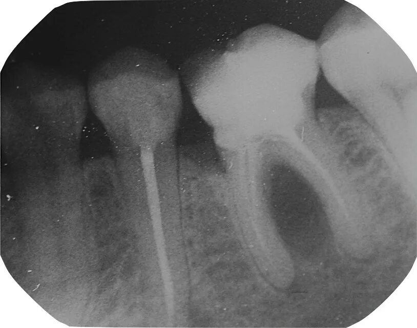 Рассосался корень зуба. Межкорневая гранулема. Воспаление корня зуба на рентгене. Периодонтит перфорация.