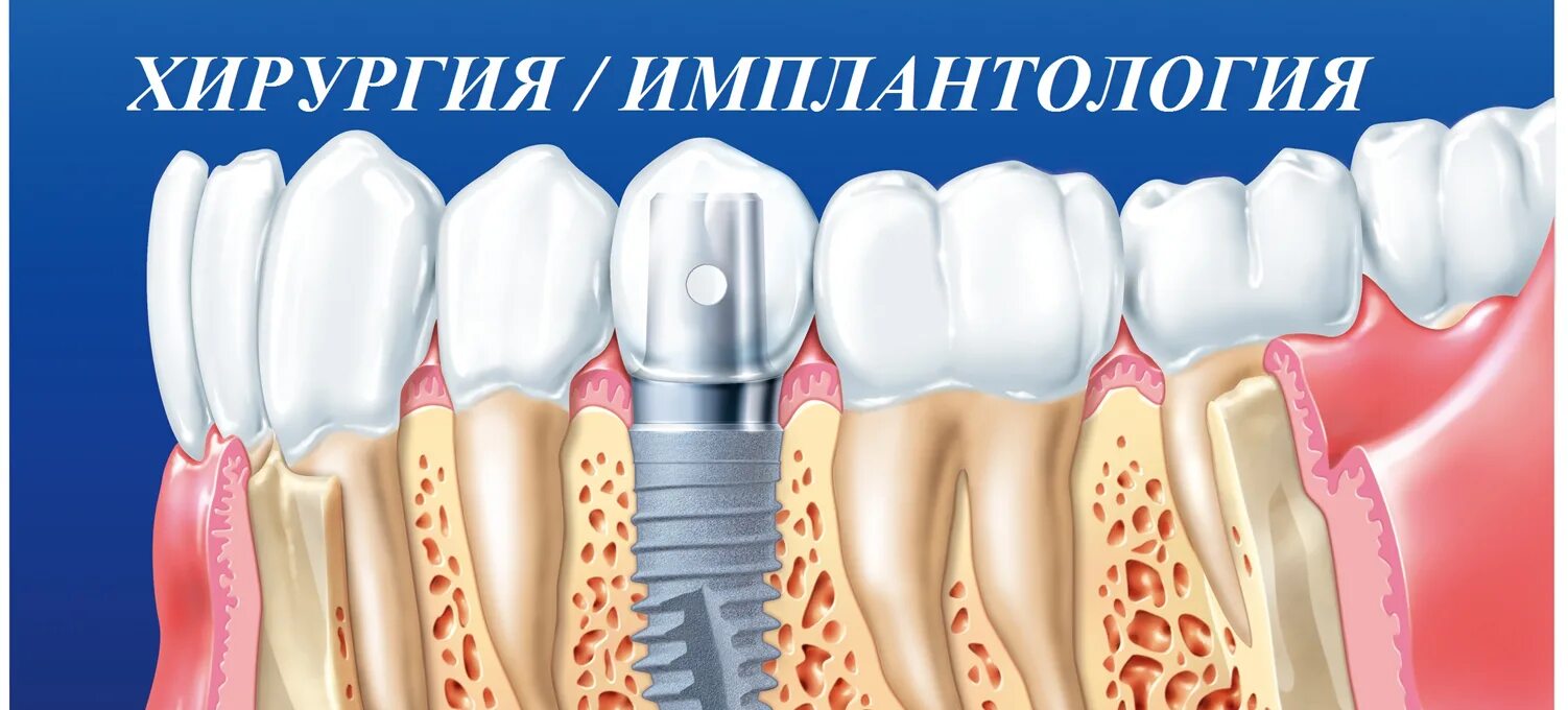 штифт стоматологический для пломбирования корневых каналов. штифт зубной анкерный. анкерный и стекловолоконный штифт. имплант или мостовидный протез. анкерный штифт в стоматологии.