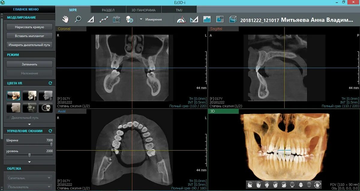 Томография зубов Пикассо компьютерная. VATECH ez3d-i. Программа ez3d Plus. Программа для кт зубов. Ez3d2009