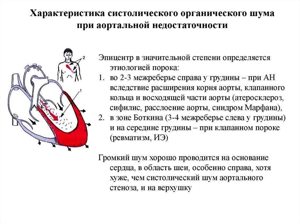 Сердечная недостаточность митрального клапана. Недостаточность аортального клапана аускультация. Аортальная недостаточность характеристика шума. Шум при аортальной недостаточности характеристика. Аортальный недостаточностьаускультация.